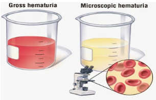 ΤΙ ΕΙΝΑΙ ΑΙΜΑΤΟΥΡΙΑ