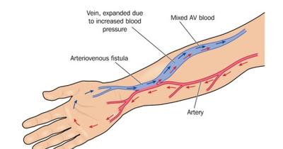 ΑV φίστουλα